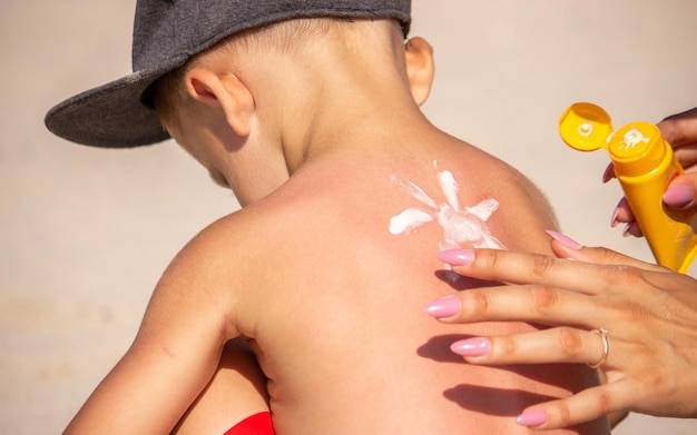 Jak usunąć oparzenia słoneczne bez wychodzenia z domu?