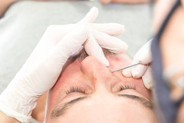 Jak pozbyć się naczynek na twarzy?